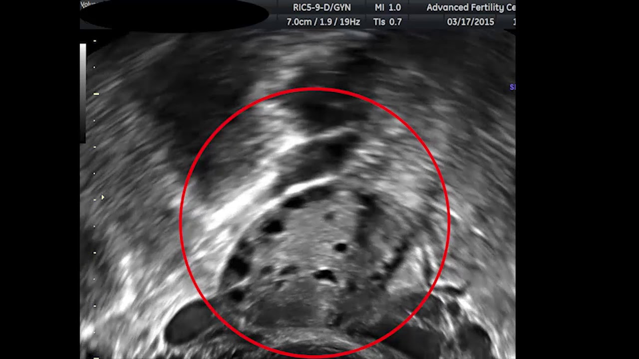 Antral Follicle Counts in Real Time