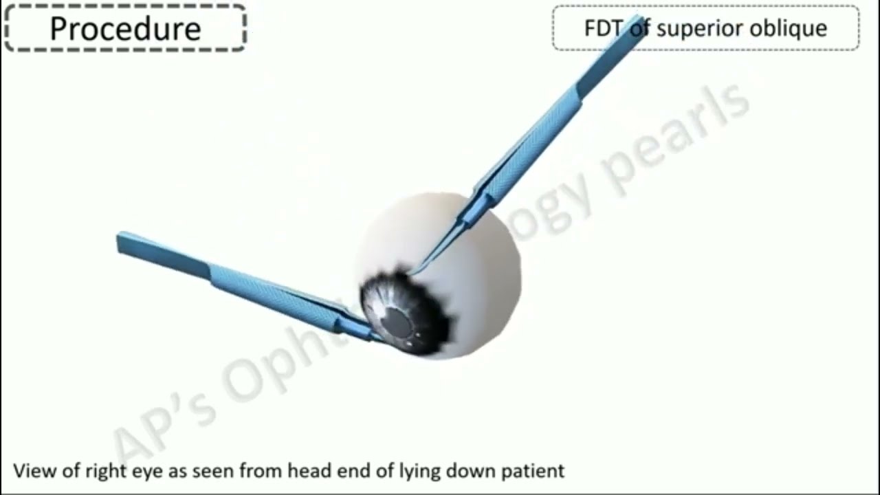 forced duction test untuk muscle entrapment orbita