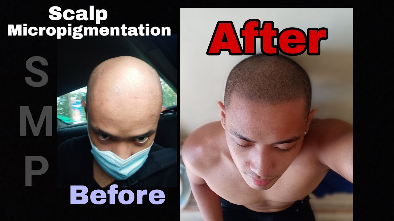 Scalp Micropigmentation or SMP