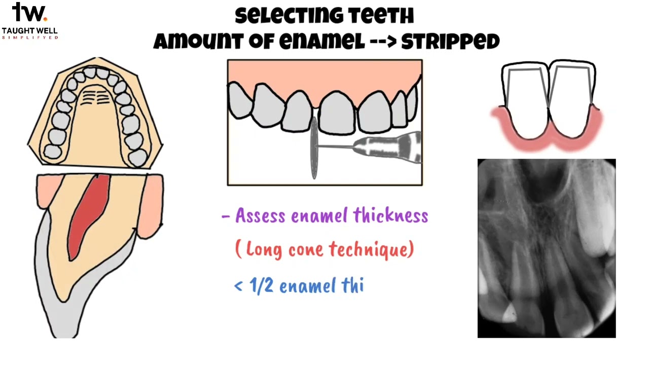 Methods of gaining space | Orthodontics