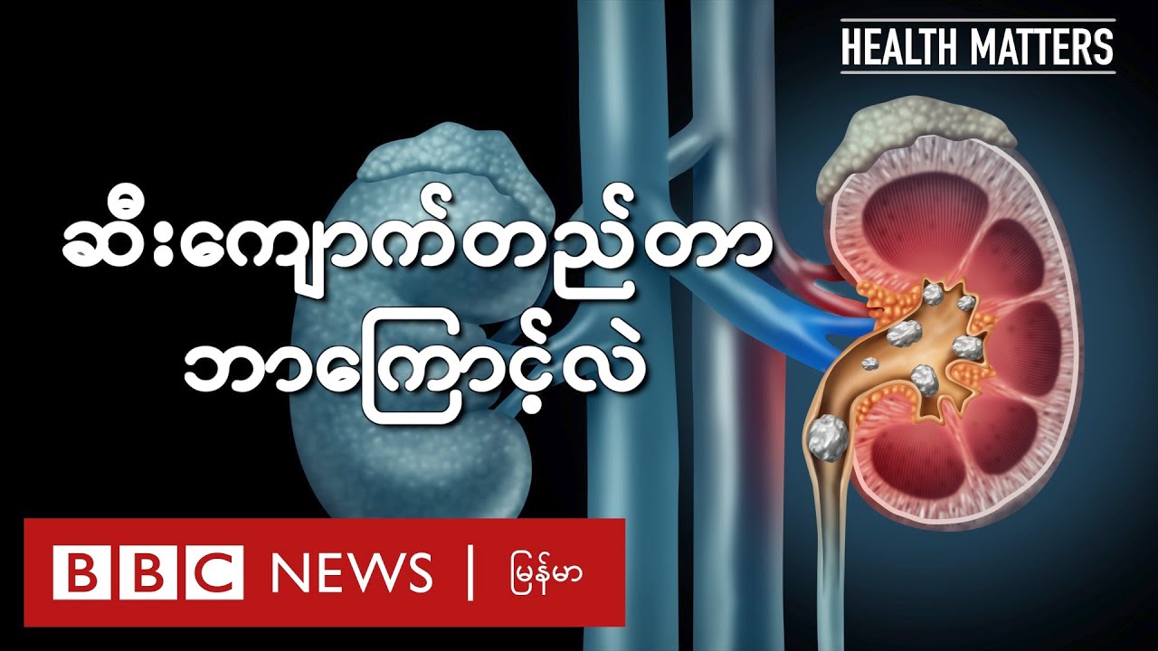ဆီးကျောက်တည်တာ ဘာကြောင့်လဲ - BBC News မြန်မာ