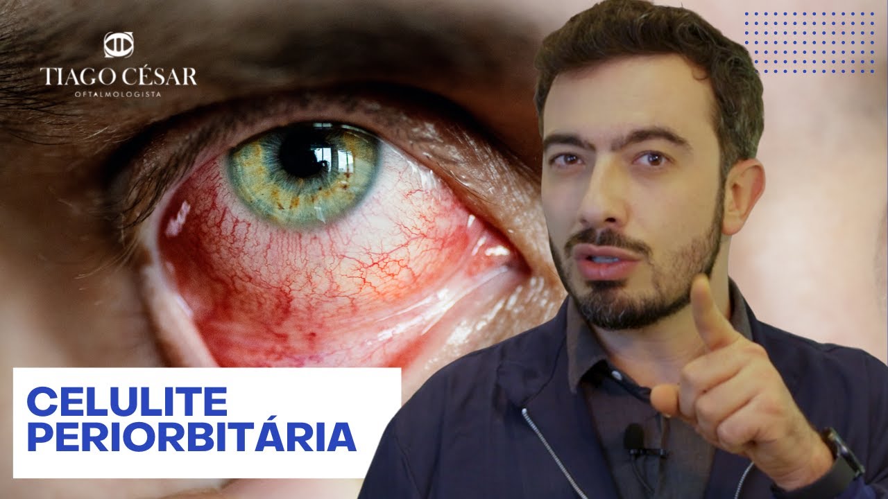 CELULITE PERIORBITÁRIA - Infecção Bacteriana que requer atenção | Dr. Tiago César