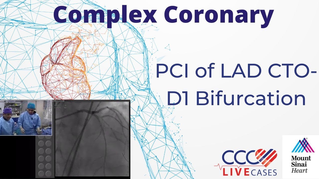 PCI of LAD CTO-D1 Bifurcation - November 2017