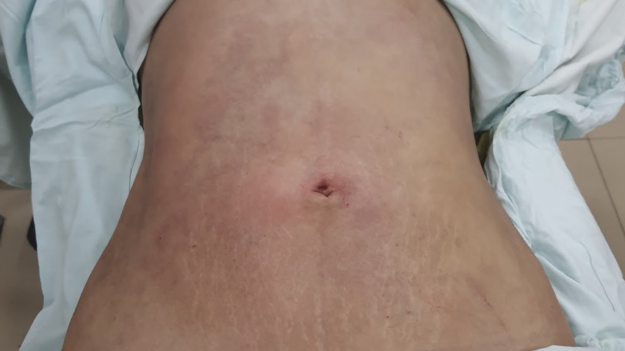 للسيدات من أمريكا لشفط البطن والجوانب مع د. الهيتمي | USA to Egypt Abdomen & Side Lipo Dr. Elhitamy