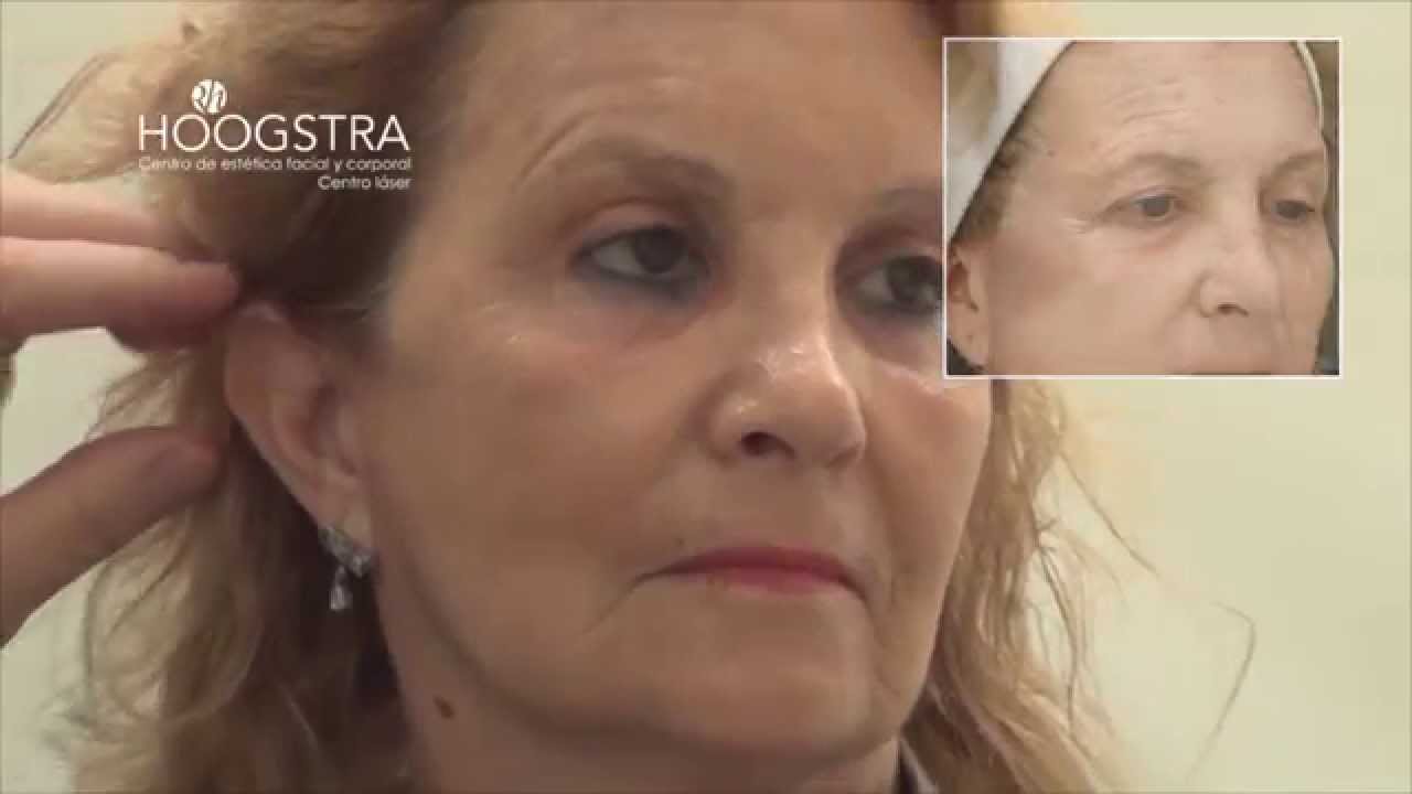 Rejuvenecimiento Facial completo - Lifting Endoscópico (14061)