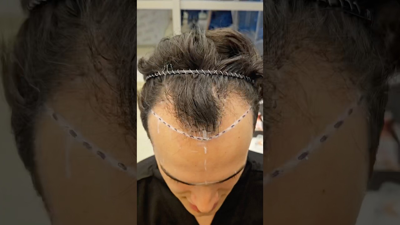 Hair transplant success: 24yo achieves high density in Norwood 3 #vincihairclinic #shorts