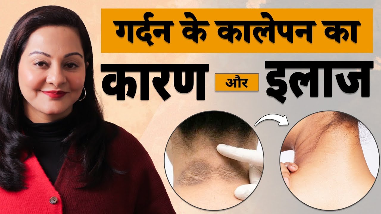गर्दन का कालापन कैसे हटाएं? | Dark Neck Treatment | Dr Niti Gaur | Best Dermatologist Gurgaon