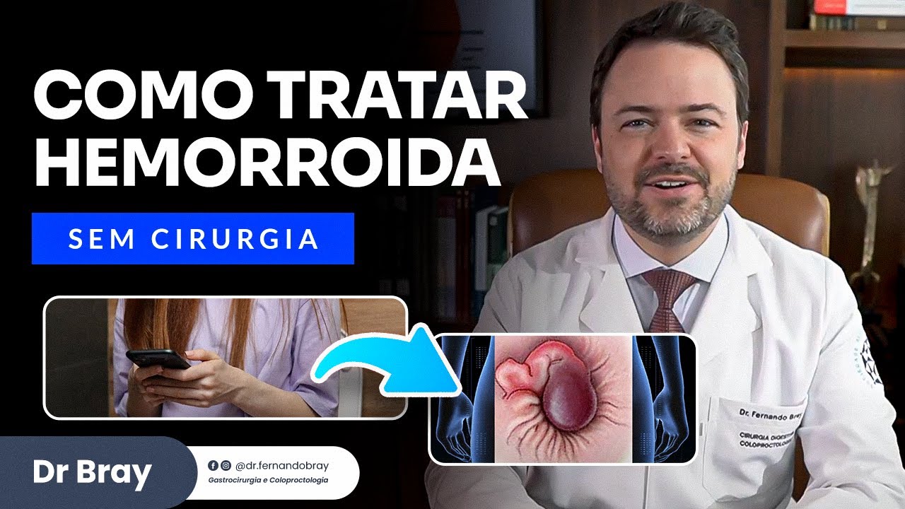 Como tratar hemorroida SEM CIRURGIA