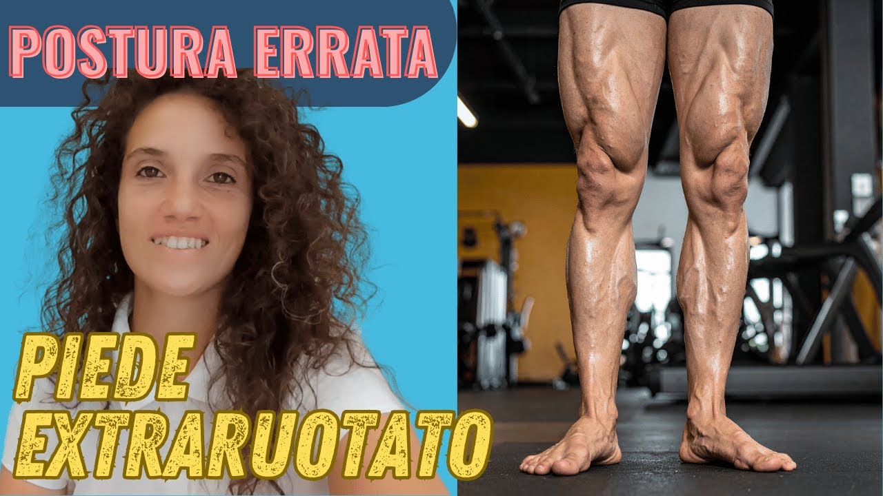🔵VIZIO POSTURALE: piedi extraruotati