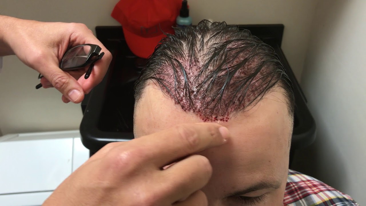 Reparative Hair Transplant One day After Using Body Hair Transplants & Scalp FUE