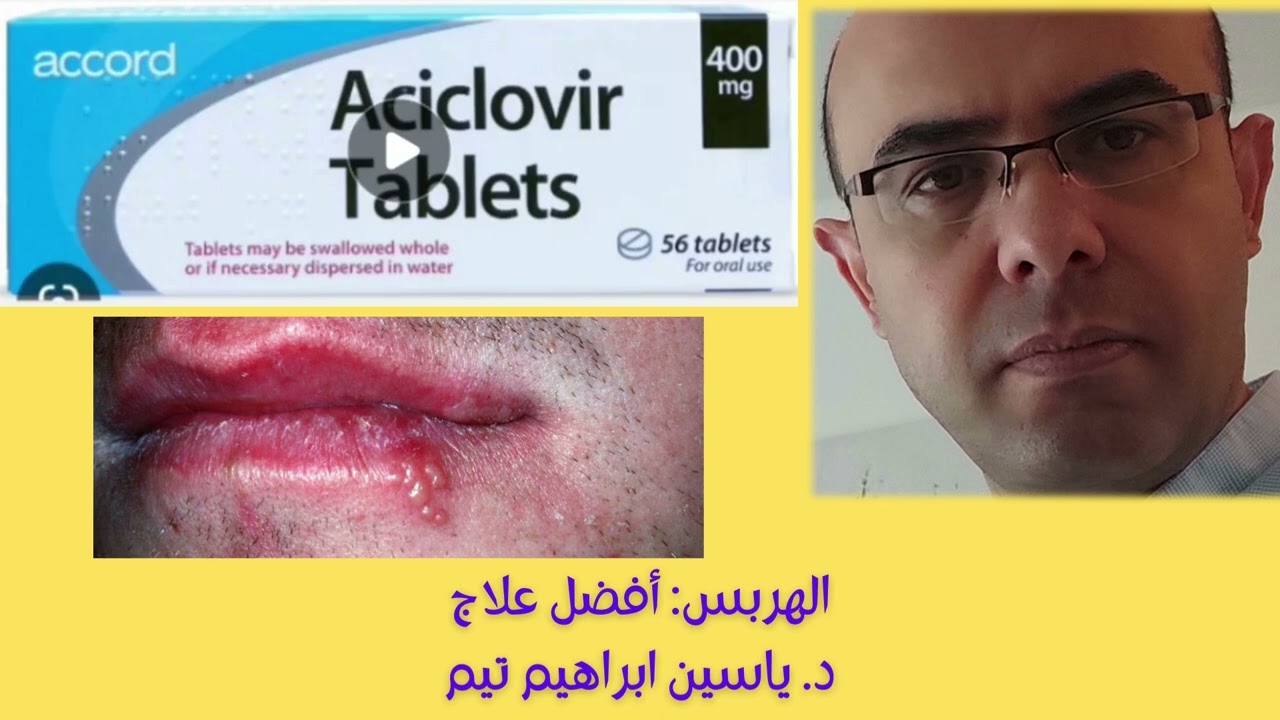الهربس: أفضل علاج