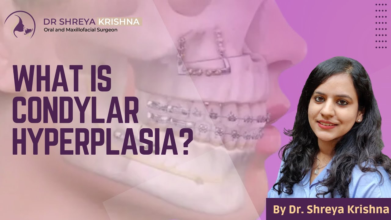 What Is Condylar Hyperplasia - Introduction, Clinical Features, Treatment | Facial Asymmetry Hindi