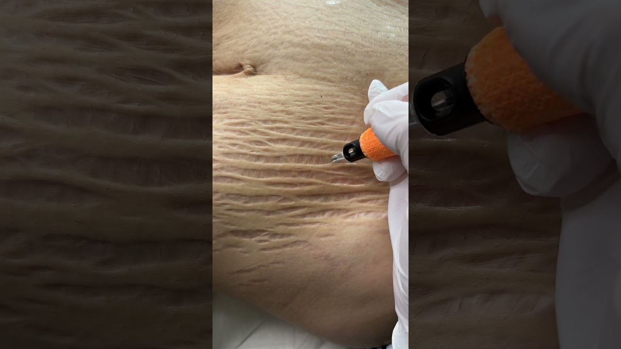⭐Stretch Marks Inkless Removal Boleyn Treatment Los Angeles  🌍 #shorts. ⭐