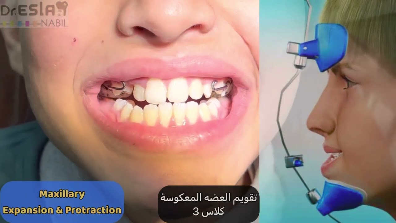مش معقول تقويم العضه المعكوسة في شهر واحد ب استخدام الزرعات التقويمية