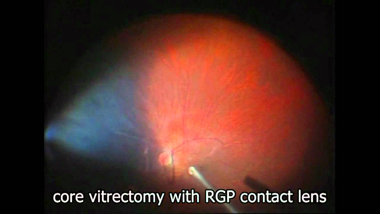 RGP contact lens for wide viewing system - Supplementary video: 33595