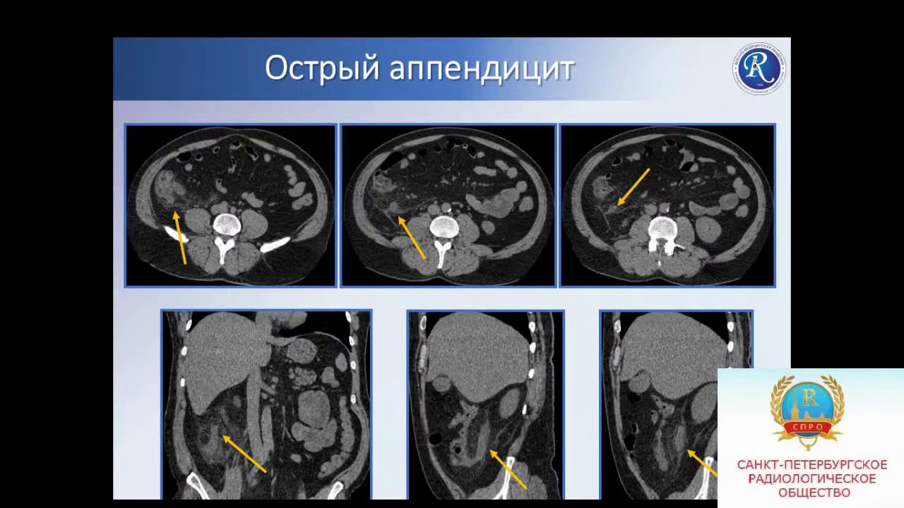 Кудрявцева А.В. «КТ диагностики острых заболеваний живота»