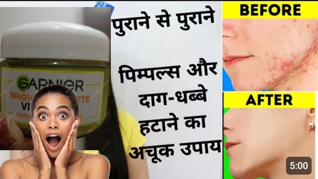 सिर्फ एक cream से ही पुराने से पुराने दाग़, निशान होगे खत्म👈face होगा गोरा👈#acne#spotify#ytshorts#yt 