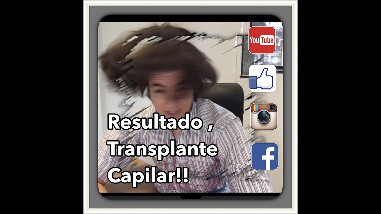 Resultado do meu Transplante capilar, após 3 anos!!!  Natural e cabelos compridos!!!