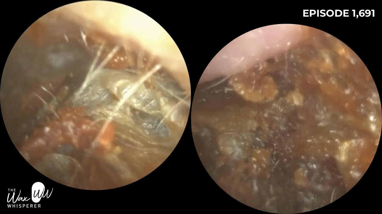 1,691 - Wrestler&rsquo;s Ear Wax Removal