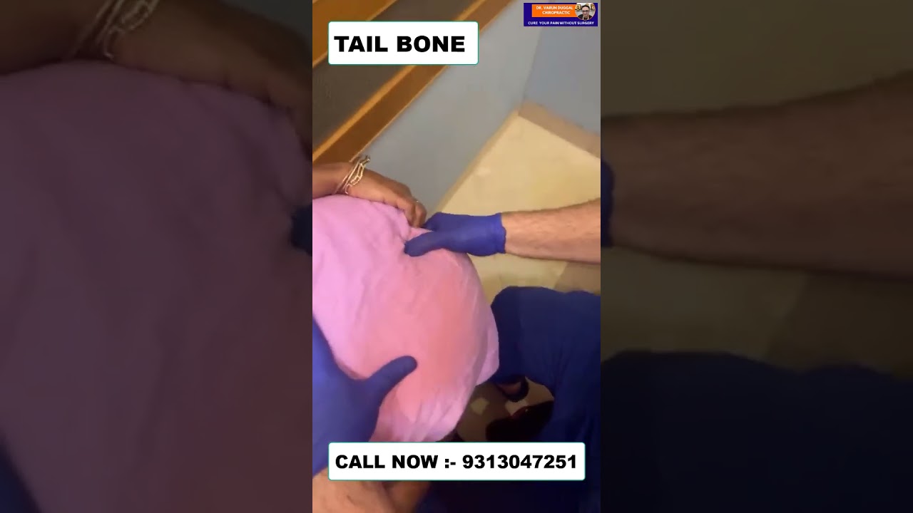 TAIL BONE | Chiropractic Treatment in Delhi | Dr. Varun | Call - 9313047251 #doctor #delhi #noida