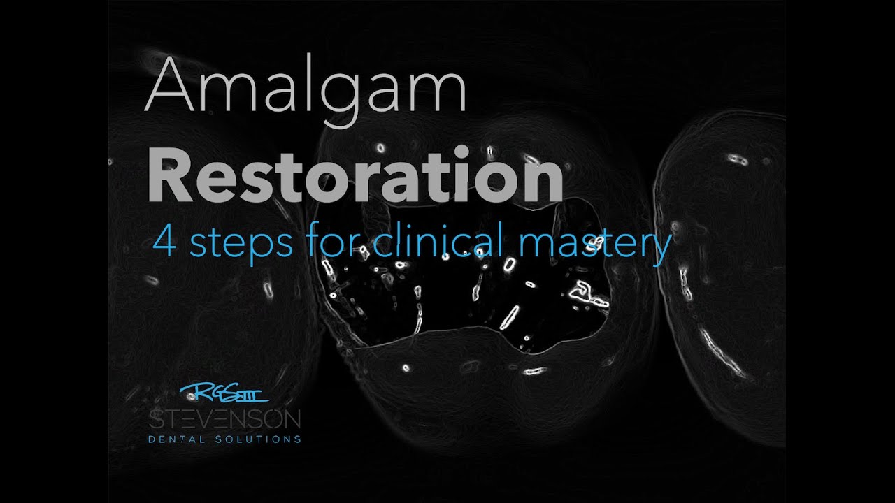 Class II Large Amalgam Restoration #14 MO Kilgore | Carving Mastery in 4 Step