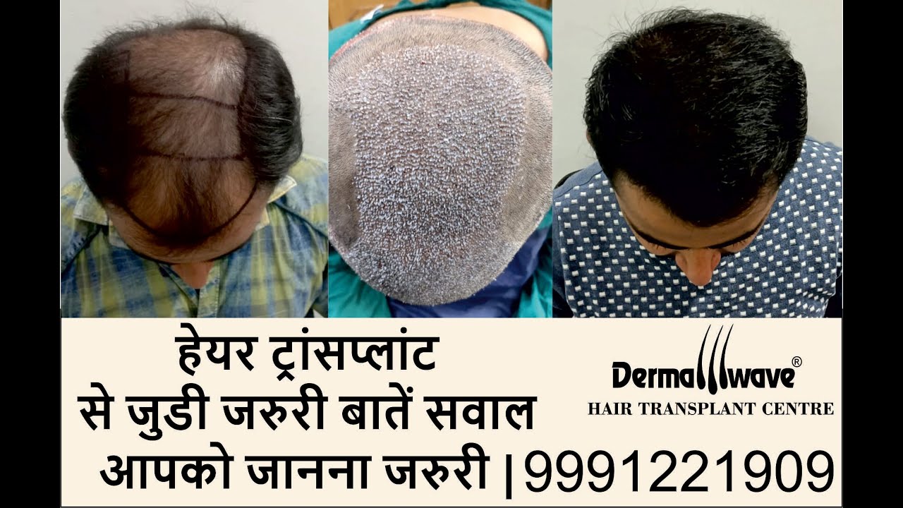 Hair Transplant Questions & Answers | Hair Transplant Ghaziabad, Ranchi, Jammu, Patna, Panipat,Delhi