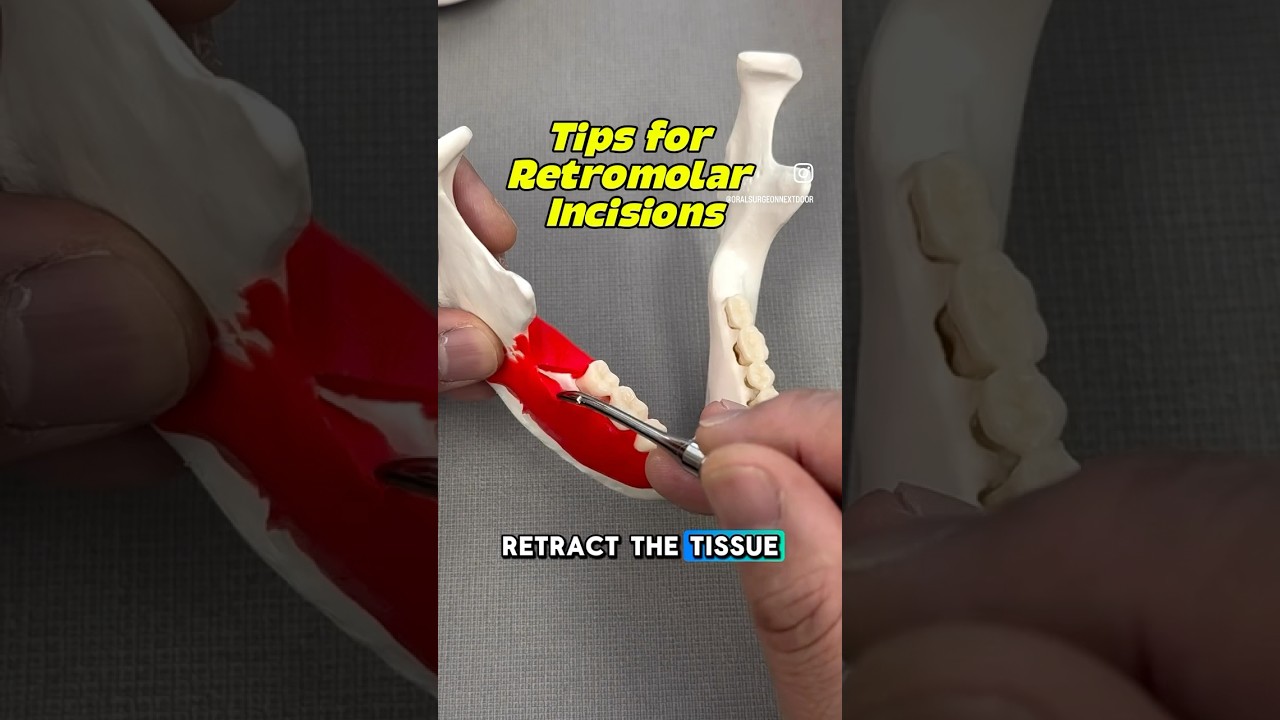Tips for Retromolar Incisions (images from Atlas of Oral & Maxillofacial Surgery)