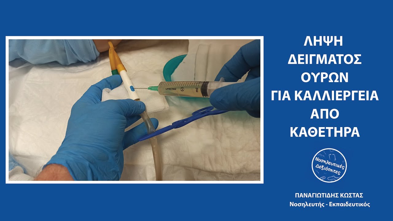 Λήψη δείγματος ούρων για καλλιέργεια από ουροκαθετήρα