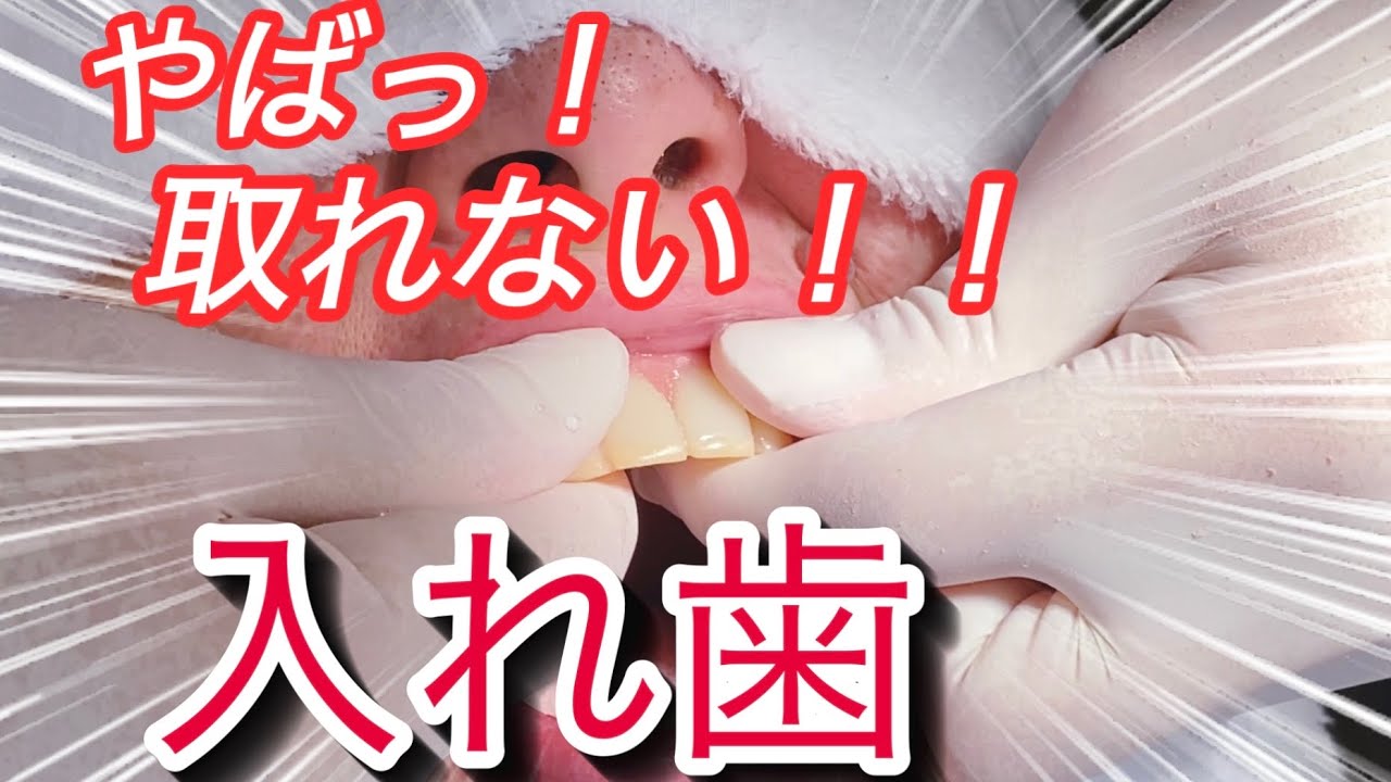 【必見！！】落ちる入れ歯を、落ちなくしてみた。