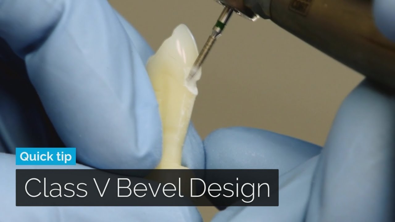 Class V Composite Bevel Design | DOTHANDSON