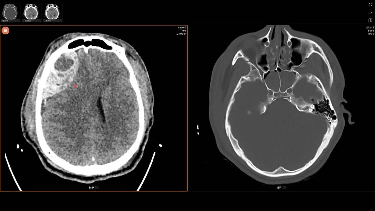 Skull fracture, epidural hematoma, orbital hematoma (EDNeurorad Case 2)