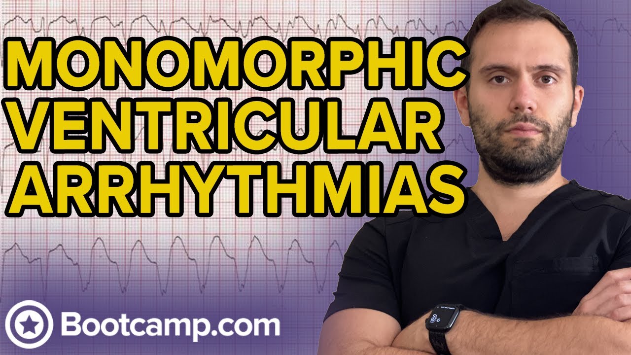 Monomorphic Ventricular Tachycardia | HIGH-YIELD CARDIOLOGY | USMLE STEP 1