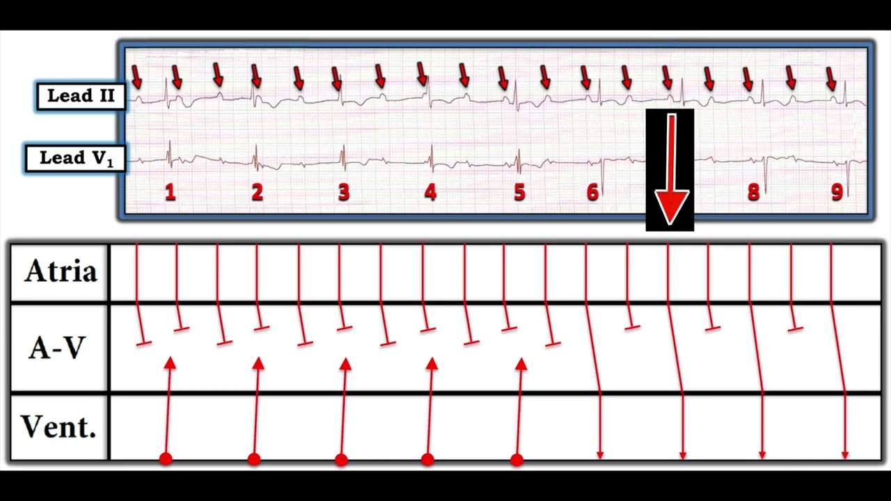 ECG Video Blog #405 &mdash; Is AV Block Complete (vs AV Dissociation &mdash; 11-25-2023)