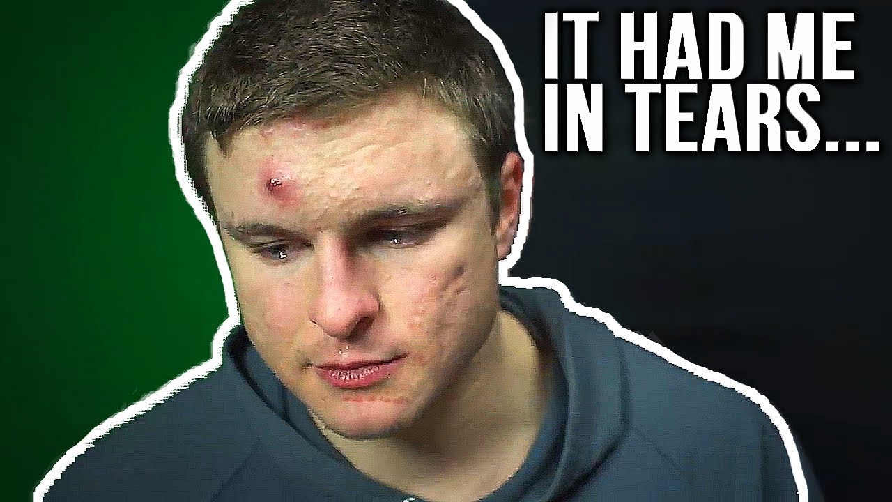 Sharing My Lowest Point (ACNE STORY)