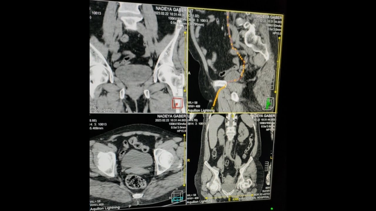 شرح كيفية رسم الحالبين في فحص الاشعه المقطعيه علي المسالك البوليه /CT ureter curve