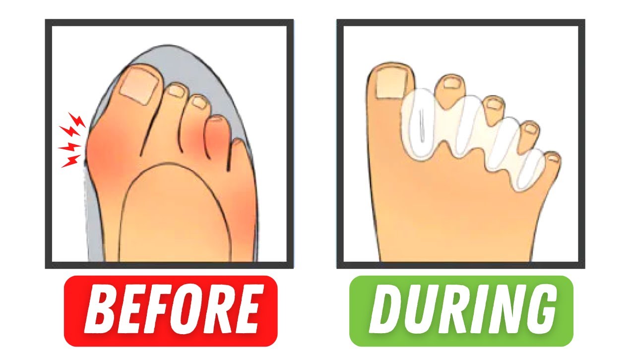 Why Toe Spacers | Can you avoid EXPENSIVE surgery?