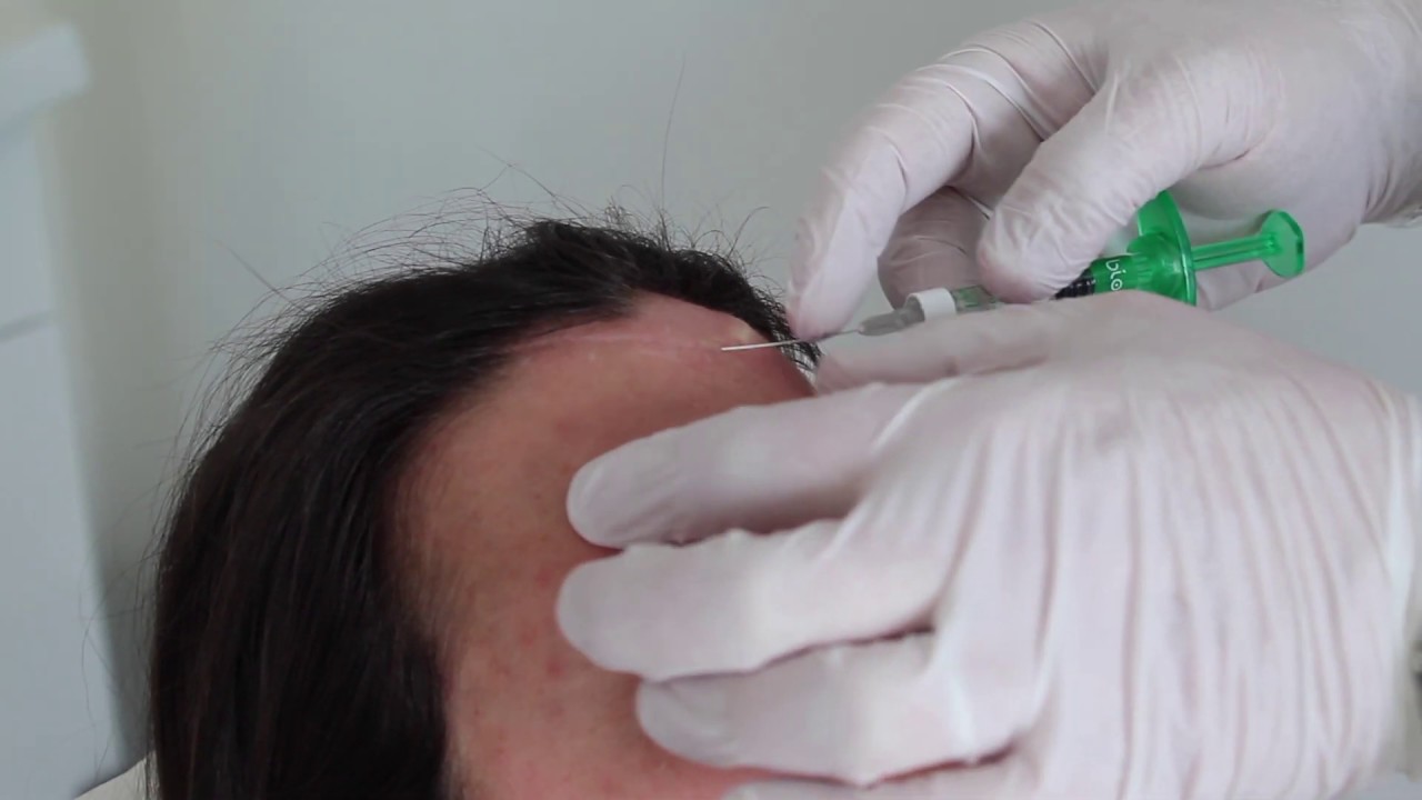 Bioregen SCARS TREATMENT