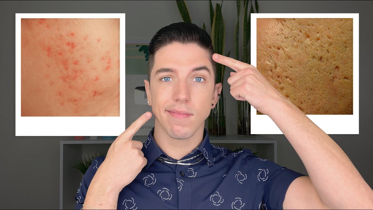 How to Get Rid of Acne Scars