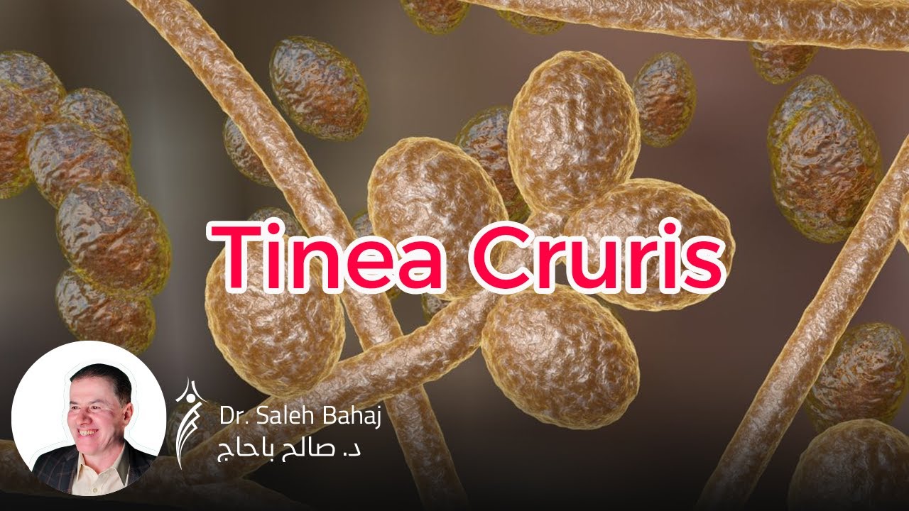 8. Tinea cruris (Jock itch)
