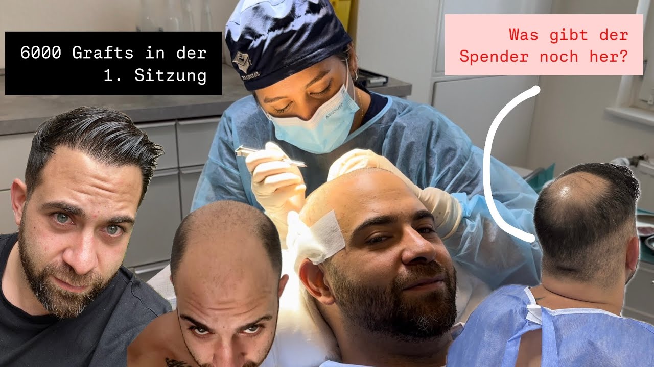 1. Haartransplantation war nicht ausreichend mit 6000 Grafts