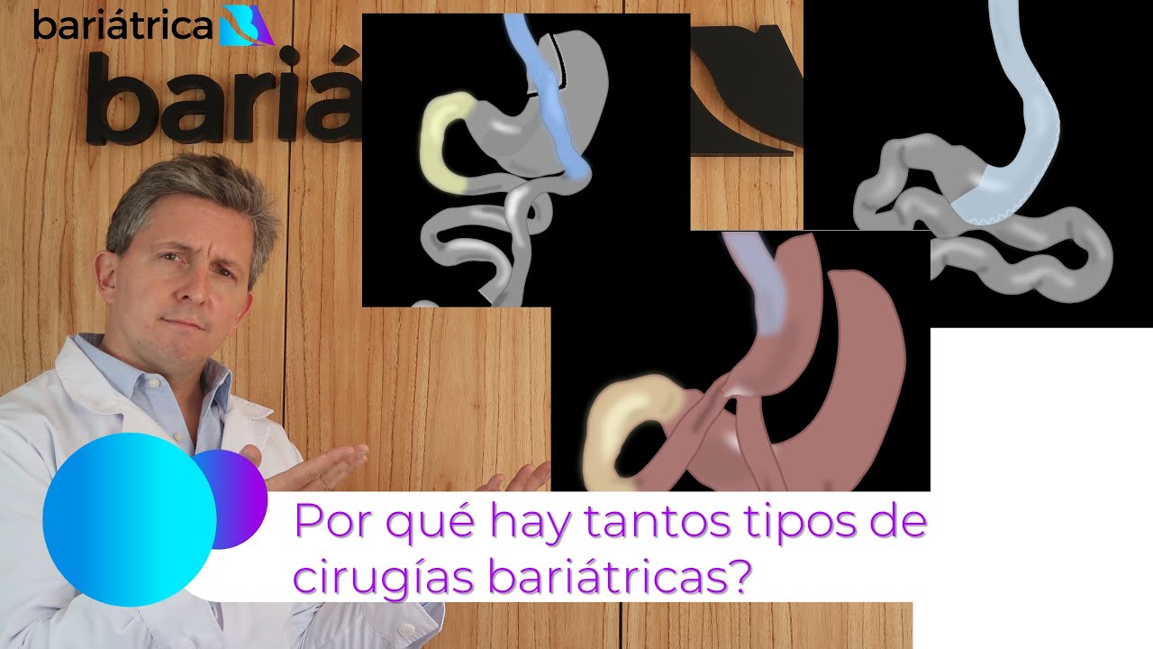 ¿Por qué hay tantos tipos de cirugías bariátricas?