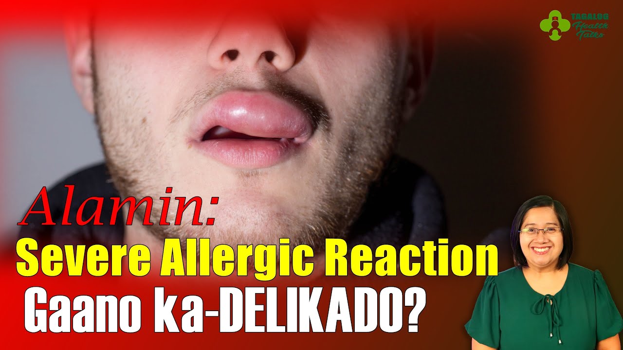 ANO ang mga SINTOMAS ng SEVERE ALLERGIC REACTIONS - Gaano ito ka DELIKADO? @tagaloginspirationaltalks_SDA