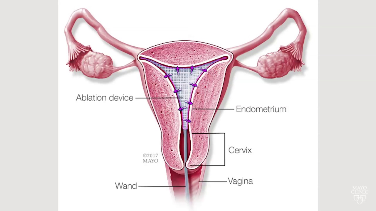 Dr. Chris DeStephano Discusses Abnormal Uterine Bleeding