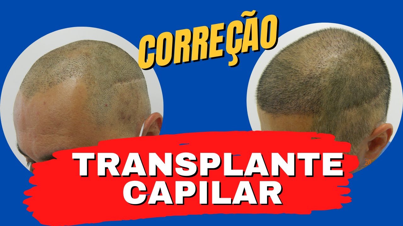 Veja resultado real #transplante #cabelo fue 10 dias em calvície grau 3/4 com correção cicatriz FUT