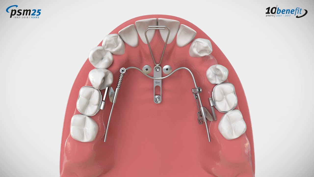 PSM - BENEfit T-Mesial-/Distalslider