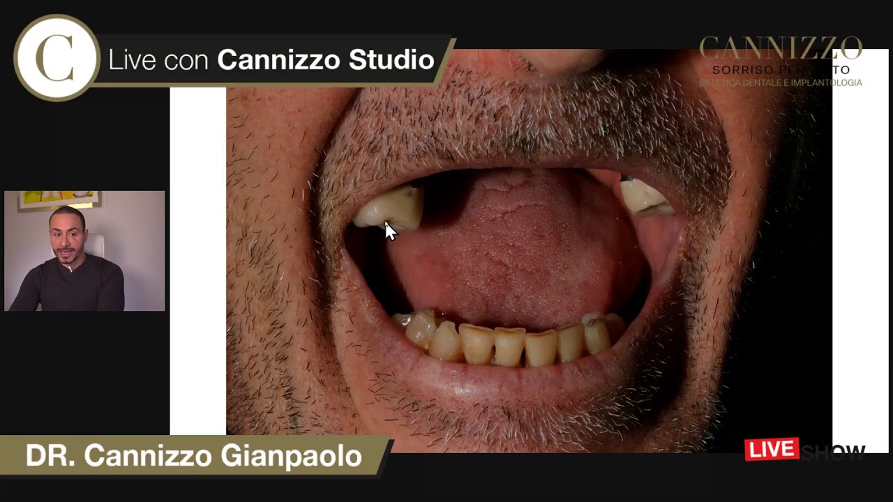 implantologia zigomatica