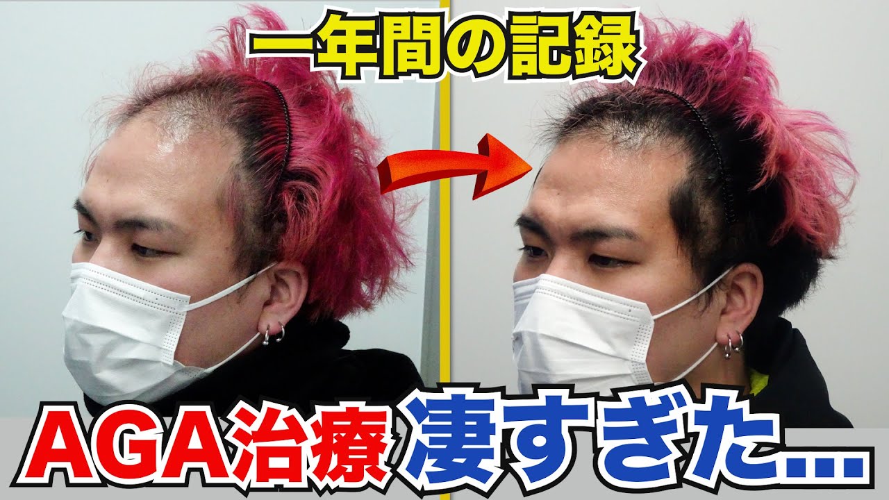 【忖度なし】薄毛治療から1年経過　生えた？金額は？クリニックは？すべてお答えします！