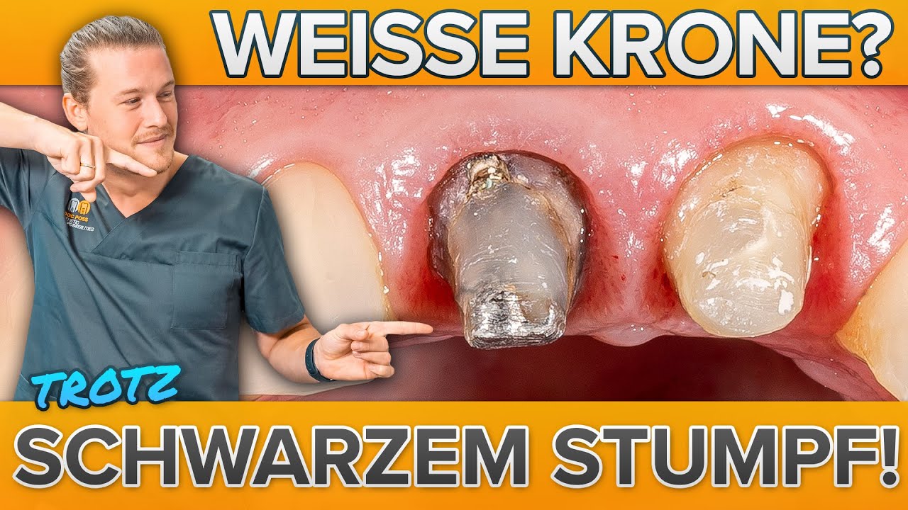 Dunkler Rand am Zahn - Dennoch weisse Krone! Wurzelbehandelter Zahn überkronen! Wieder lächeln!