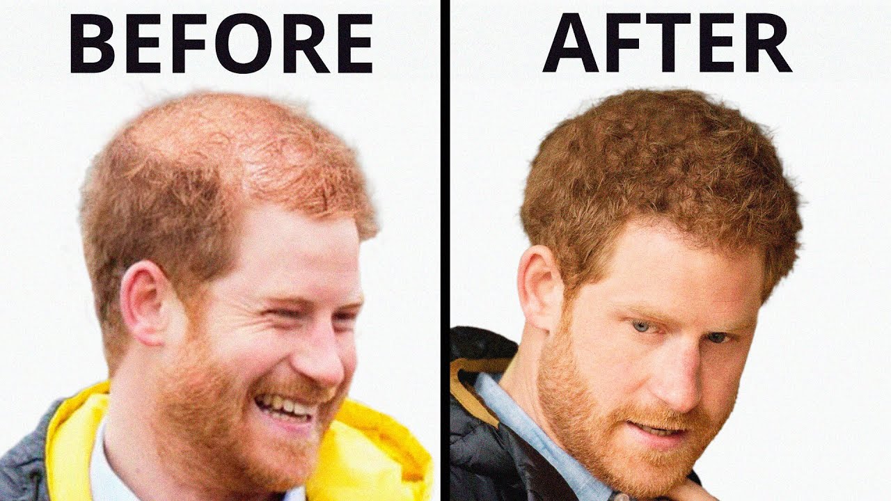 Prince Harry's Hair Transplant | Plastic Surgery Analysis
