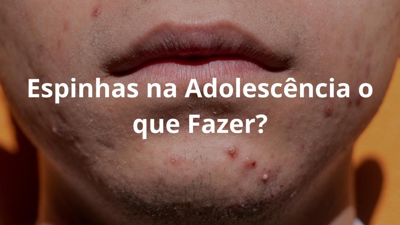 O Maior Vilão do adolescente a Acne e Cuidados Com a Pele Mitos e Verdades na Saúde do Adolescente